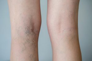 PEIM (Procedimento Estético Injetável para Microvasos) - ITA Educacional