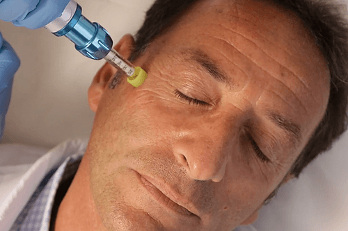 intradermoterapia.png