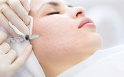 Intradermoterapia Injetável ou Mesoterapia: o que é e quais são os benefícios