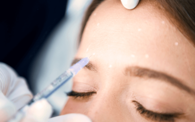 Botox preventivo ou preenchimento: entenda como funciona