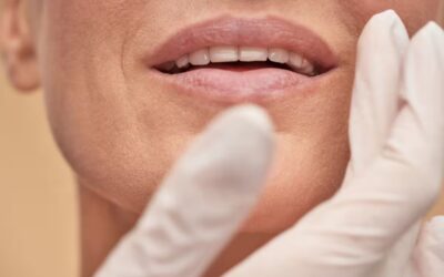 Rugas periorais: o que são e quais procedimentos indicar ao paciente