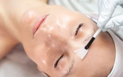 Peelings avançados na prática clínica