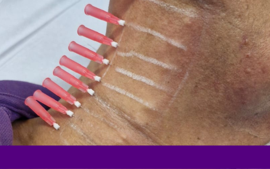 Fisioterapeuta Pode Trabalhar com Injetáveis? Descubra Como Atuar na Estética Avançada