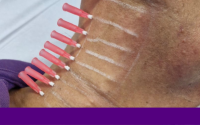 Fisioterapeuta Pode Trabalhar com Injetáveis? Descubra Como Atuar na Estética Avançada